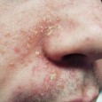 Cum sa scapi de dermatita seboreica (cojile din barba, perciuni si scuamele la nivelul scalpului), neurodermatita si alte afectiuni ale pielii